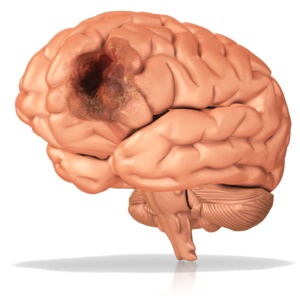 A brain with a diseased area on the frontal lobe.