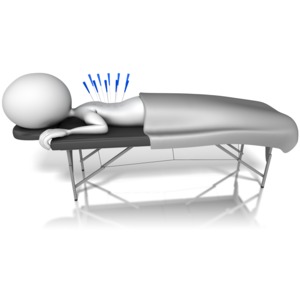This clip art image shows a figure getting acupuncture.