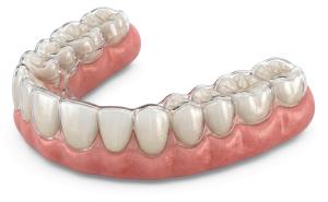 Download this Presentation Clipart to illustrate invisible dental correction solutions effectively.