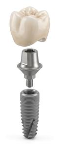 Tooth Implant PowerPoint clipart graphic preview.