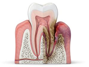 Download this Presentation Clipart showcasing a normal tooth vs decay for effective dental health education.